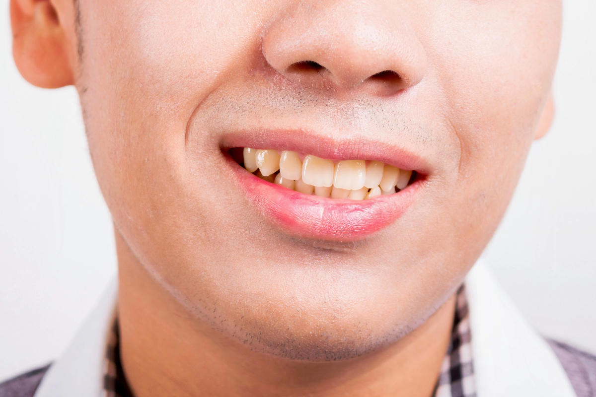 what causes tooth discoloration