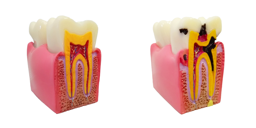 Common Symptoms After a Root Canal and When to Call Your Dentist